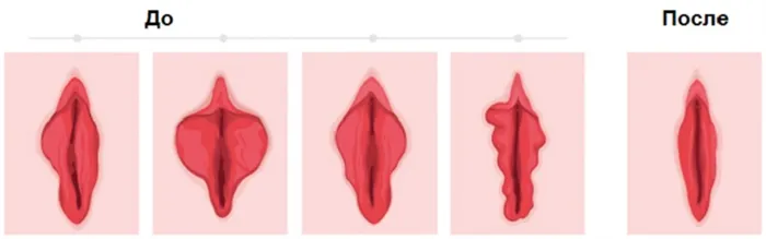 Как выглядят ваши губы до и после увеличения губ