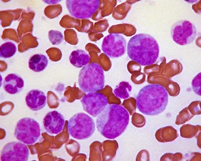 Причины и факторы риска лейкемии (лейкоз и рак крови)