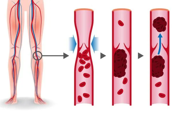 Разрушенный тромб - одна из причин обструкции легочной артерии