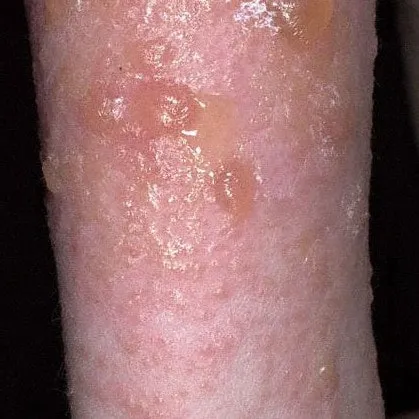 В случае серьезного поражения лимфатических узлов, лимфа выделяется из неповрежденной кожи.
