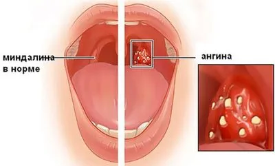 Здоровые и воспаленные миндалины в горле