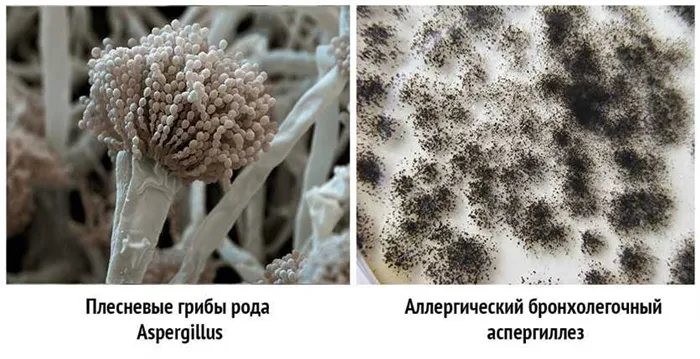 Аспергиллез аллергический и грибы рода Aspergillus