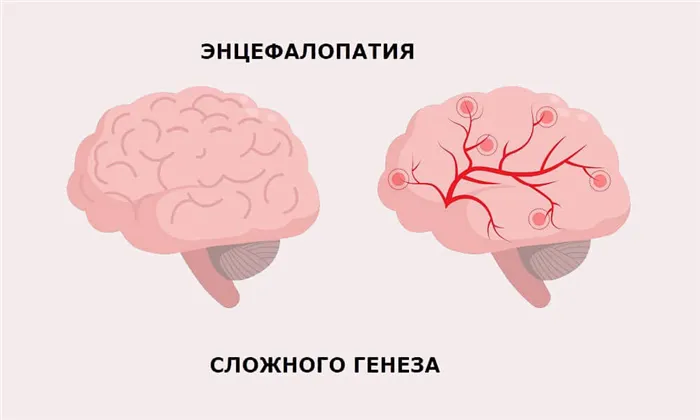 Сравнение нормального мозга и больного энцефалопатией