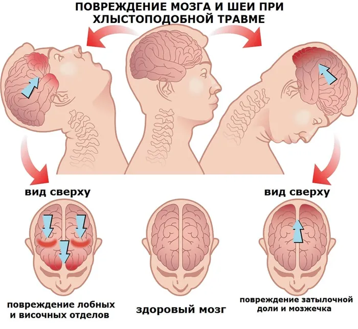 Механизм травмы мозга