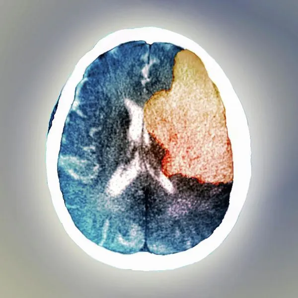 МРТ головного мозга: повреждение правого полушария при ишемии, которое стало причиной бредового расстройства