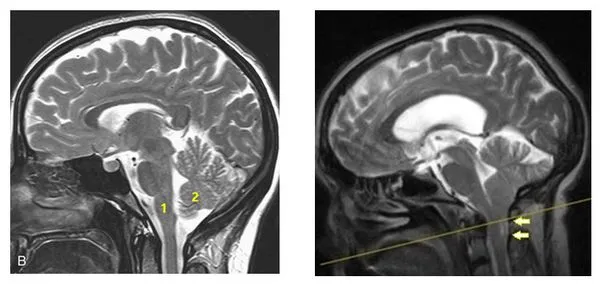 МРТ головного мозга, сагиттальный срез (T2 режим)